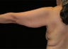 Arm Lift