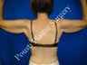 Arm Lift 