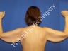 Arm Lift 