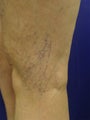 spider vein treatments
