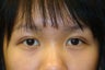 Double lid Asian blepharoplasty