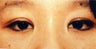 Asian Eyelid Surgery (Blepharoplasty) ~ Suture Method