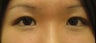Asian Eyelid Surgery