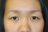 Double lid Asian blepharoplasty
