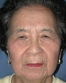 Lateral Browlift & Upper Lid Blepharoplasty