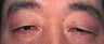 Eyelid Surgery