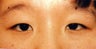 Asian Eyelid Surgery (Blepharoplasty) ~ Suture Method