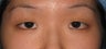 Asian Eyelid Surgery
