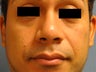 Rhinoplasty