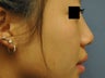 Asian Rhinoplasty