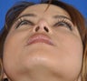 Rhinoplasty-Nostril shaping