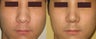 Rhinoplasty