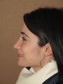Nose job/ rhinoplasty