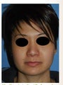 Asian Rhinoplasty Before and After