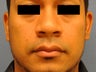 Rhinoplasty