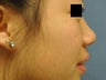 Asian Rhinoplasty