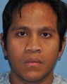 Rhinoplasty-Asian