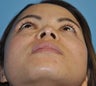 Rhinoplasty-Nostril shaping