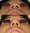Rhinoplasty