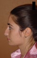 Nose job/ rhinoplasty