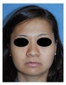 Asian Rhinoplasty Before and After