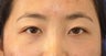 Asian Eyelid Surgery
