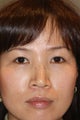 Asian Blepharoplasty