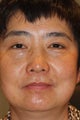Asian Blepharoplasty
