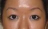 Asian Blepharoplasty