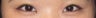 Asian Eyelid Surgery