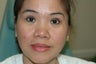 Asian eyelid surgery --  Double lid crease procedure
