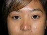 Asian eyelid surgery