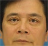 Blepharoplasty, Eyelid Surgery
