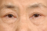 Asian Eyelid Surgery