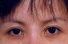 Asian eyelid surgery