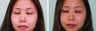 Double eyelid surgery suture