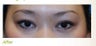 Asian Double Eyelid Incisional Technique