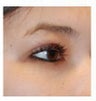 Asian Eyelid Double Eyelid Crease Formation Incisional Technique