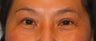 Asian Eyelid Surgery