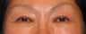 Asian Eyelid Surgery