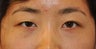 Asian Eyelid Surgery