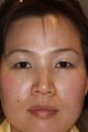Asian Blepharoplasty