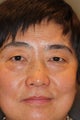 Asian Blepharoplasty