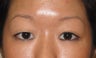 Asian Blepharoplasty
