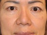 Asian Blepharoplasty