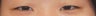 Asian Eyelid Surgery