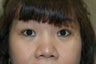 Asian eyelid surgery --  Double lid crease procedure