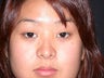 Asian eyelid surgery