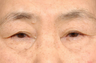 Asian Eyelid Surgery