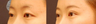 Double Eyelid Surgery Non-Incision